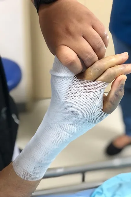 Debridement