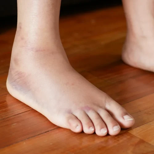 diabetic-wound-care-in-arkansas