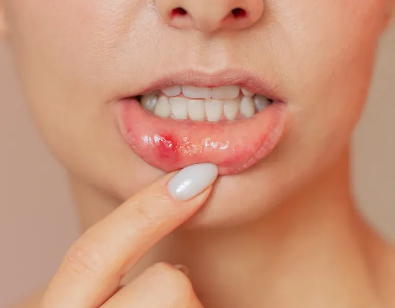 symptoms-of-skin-ulcers